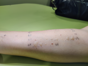 SKIN PRICK ALLERGY TEST 